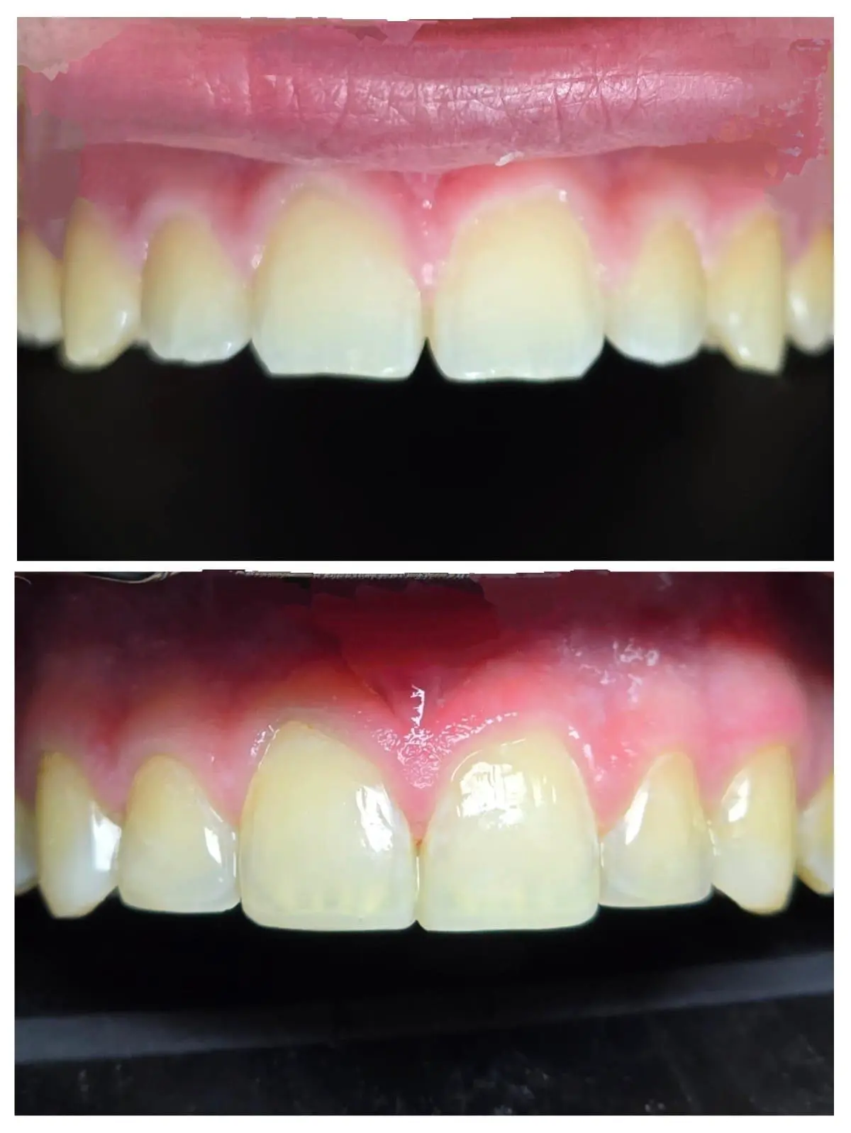 facings2 esthetische tandarts