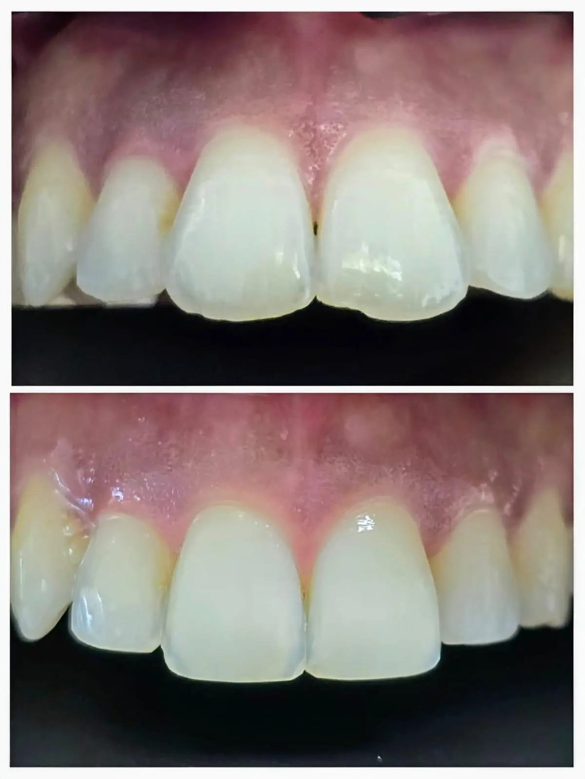 facings3 esthetische tandheelkunde